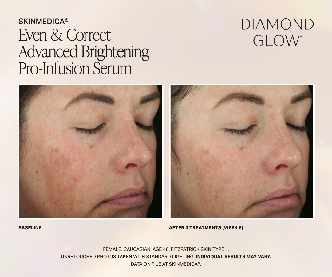 Before and after diamond glow treatment results comparison