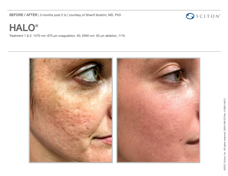 Before and after skin treatment results