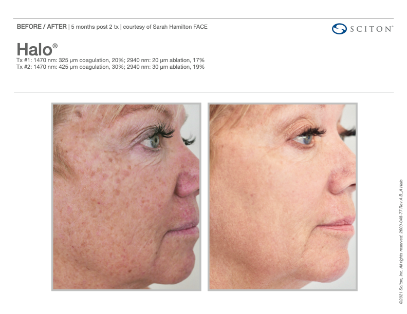 Before and after skin treatment results comparison.