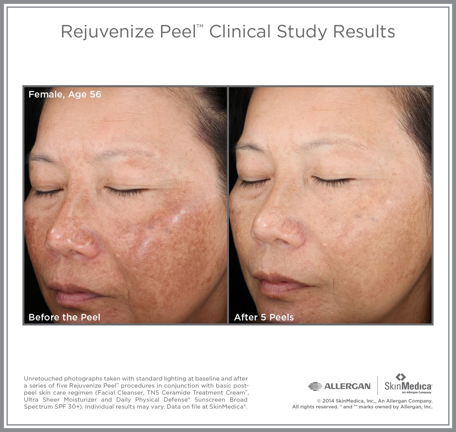 Rejuvenize Peel results before and after treatment.